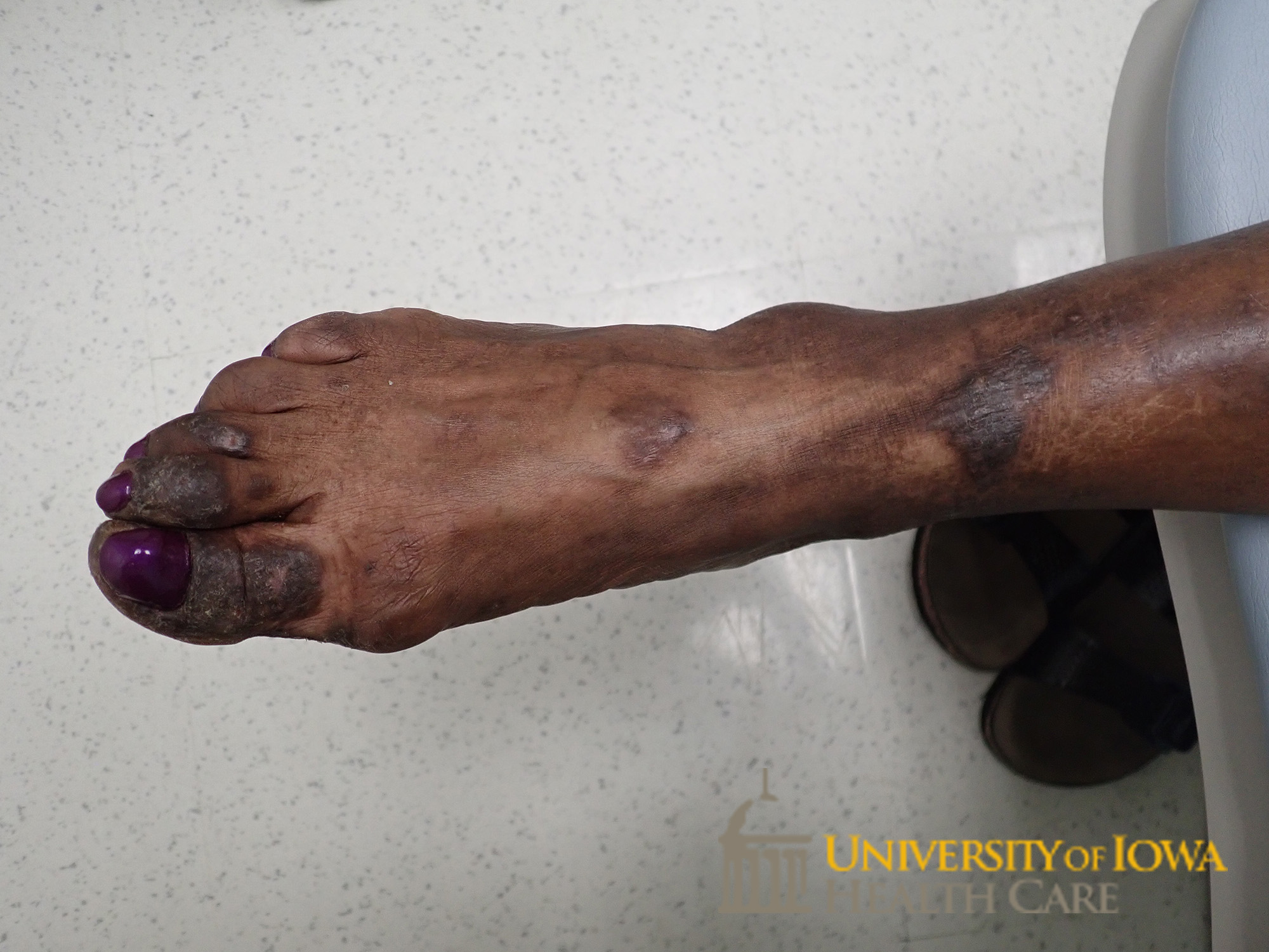 Hyperpigmented scaly plaques on the distal dorsal toes. (click images for higher resolution).